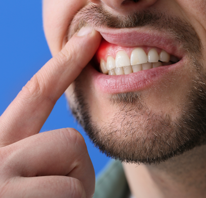 Bleeding Gum Treatment Vijayawada